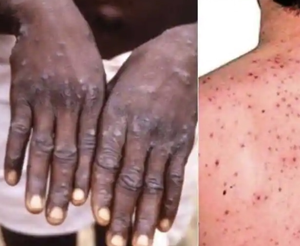 Alert — CDC monitoring outbreak of Monkeypox… 200 people in 27 states… |